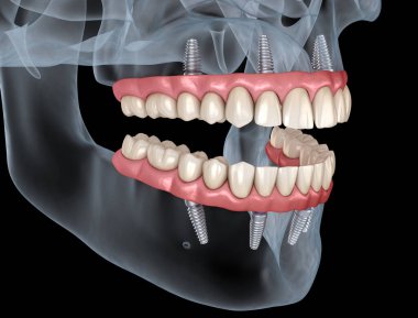 Maxillary and Mandibular prosthesis with gum All on 4 system supported by implants. Medically accurate 3D illustration of human teeth and dentures clipart