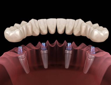 Mandibular prosthesis All on 4 system supported by implants. Medically accurate 3D illustration of human teeth and dentures concept clipart