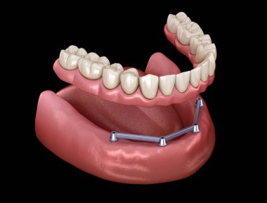 Çikletli çene protezi. Hepsi de implantlar tarafından desteklenen 4 sistemde. İnsan dişleri ve protez kavramının tıbben doğru üç boyutlu çizimi