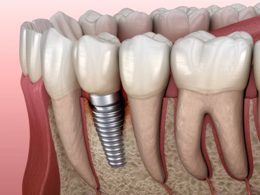 Görülebilir kemik hasarlı perisiplantit. Diş implantı kavramının tıbben doğru üç boyutlu çizimi