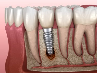 Görülebilir kemik hasarlı perisiplantit. Diş implantı kavramının tıbben doğru üç boyutlu çizimi