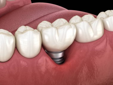 Çiklet durgunluğu olan Peri-implantitis. Diş implantı kavramının tıbben doğru üç boyutlu çizimi