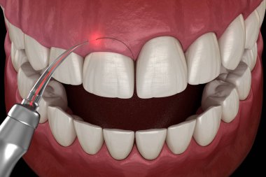 Lazerle Gingivectomi ameliyatı. Tıbbi olarak doğru diş 3D illüstrasyon