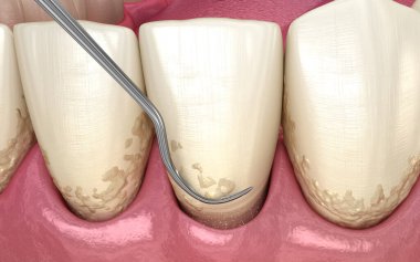 Ağız temizliği: Ölçekleme ve kök planlama (geleneksel periodontal terapi). İnsan diş tedavisinin tıbbi açıdan doğru üç boyutlu çizimi