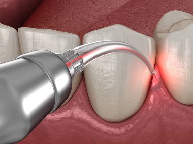 Lazerle sakız düzeltme ameliyatı. Tıbbi olarak doğru diş 3D illüstrasyon