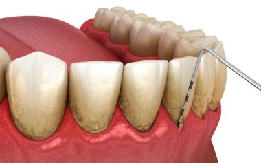 Gum recession test. Medically accurate 3D illustration