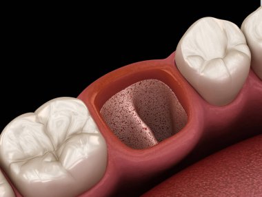 Alveolitler - diş çekildikten sonra kurudu. Tıbbi olarak doğru 3B illüstrasyon