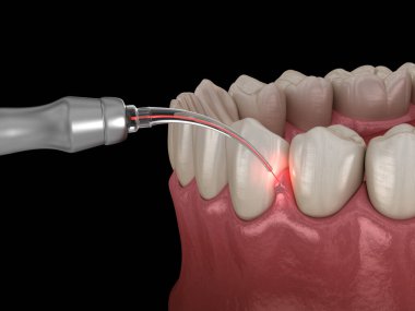 Lazerle sakız düzeltme ameliyatı. Tıbbi olarak doğru diş 3D illüstrasyon