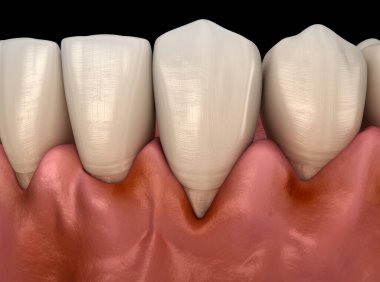 Diş etlerinde diş eti iltihabı. Tıbbi olarak doğru 3B illüstrasyon