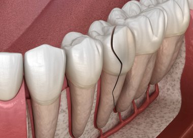 Kırık diş, çatlamış. Tıbbi olarak doğru 3B illüstrasyon