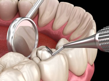 Bileşik dolgusu olan çürük diş restorasyonu. Tıbbi olarak doğru diş 3D illüstrasyon.