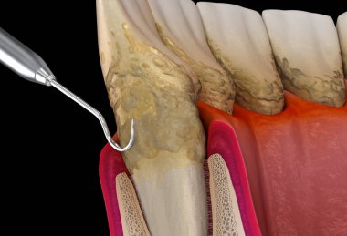 Oral hygiene: Scaling and root planing of Periodontitis stage 3 (conventional periodontal therapy). Medically accurate 3D illustration of human teeth treatment clipart