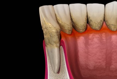 Periodontit aşaması 3, sakız resesyonu, tartar. Tıbbi olarak doğru 3B illüstrasyon