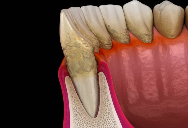 Periodontit aşaması 3, sakız resesyonu, tartar. Tıbbi olarak doğru 3B illüstrasyon