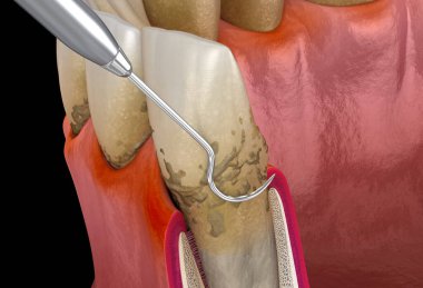 Ağız temizliği: Ölçekleme ve kök planlama (geleneksel periodontal terapi). İnsan diş tedavisinin tıbbi açıdan doğru üç boyutlu çizimi