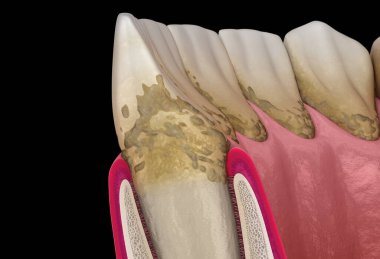 Periodontit aşaması 1, sakız durgunluğu, tartar. Tıbbi olarak doğru 3B illüstrasyon