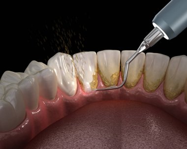Ağız hijyeni: Ultrasonik diş temizleme makinesi kalkülüs ve plak kaldırma. İnsan diş tedavisi tıbbi olarak doğru 3d illüstrasyon