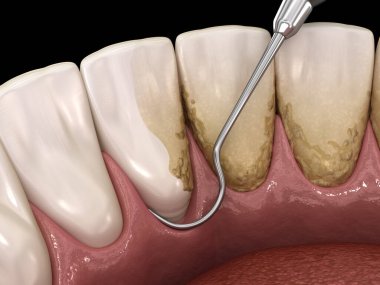 Ağız temizliği: Ölçekleme ve kök planlama (geleneksel periodontal terapi). İnsan diş tedavisinin tıbbi açıdan doğru üç boyutlu çizimi