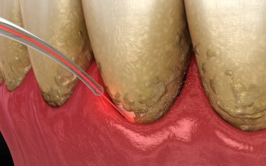 Lazer tartarı, enfekte olmuş deri tabakasını ve diş temizliğini temizler. Tıbbi olarak doğru diş 3D illüstrasyon