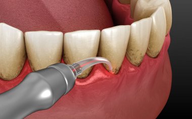 Lazer tartarı, enfekte olmuş deri tabakasını ve diş temizliğini temizler. Tıbbi olarak doğru diş 3D illüstrasyon