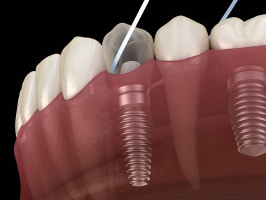 Diş ipi ile implant diş temizliği. Tıbbi olarak doğru 3d illüstrasyon