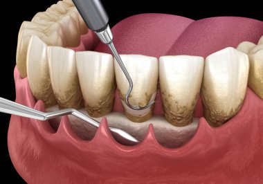 Açık curettage: Ölçekleme ve kök planlama (geleneksel periodontal terapi). İnsan diş tedavisinin tıbbi açıdan doğru üç boyutlu çizimi