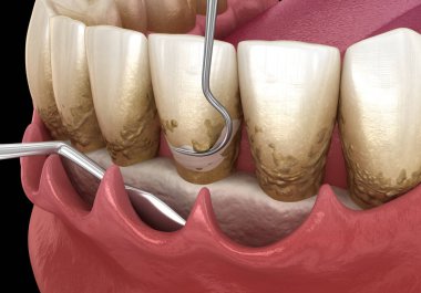 Açık curettage: Ölçekleme ve kök planlama (geleneksel periodontal terapi). İnsan diş tedavisinin tıbbi açıdan doğru üç boyutlu çizimi