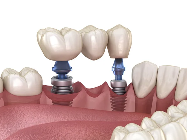 由植入物支撑的牙桥 医学上准确的人类牙齿和假牙概念三维图像 — 图库照片