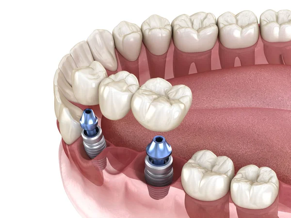 Dental bridge supported by implants. Medically accurate 3D illustration of human teeth and dentures concept