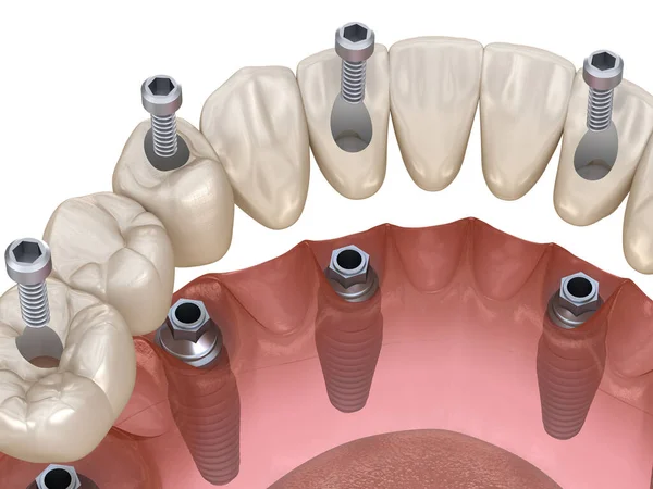 Prothèse Mandibulaire Tout Sur Système Soutenu Par Des Implants Fixation — Photo