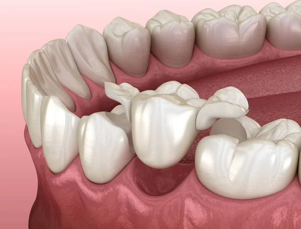 Ponte Del Maryland Ceramica Recupero Premolare Dei Denti Illustrazione Clinicamente — Foto Stock