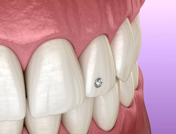 Tooth piercing by diamond, 3D illustration concept.