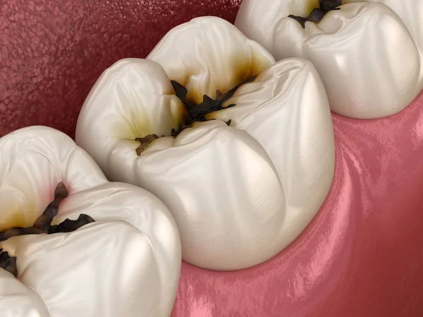 ケアによって損傷を受けた臼歯 医学的に正確な歯3Dイラスト — ストック写真