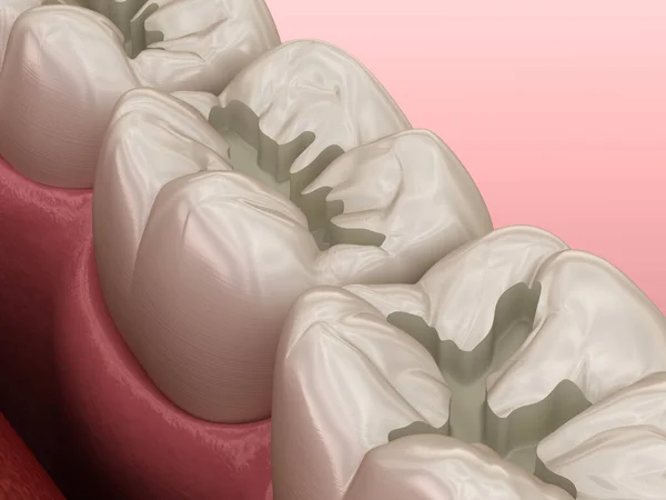 充填剤の配置のための準備モル安全性 歯科概念の医学的に正確な3Dイラスト — ストック写真