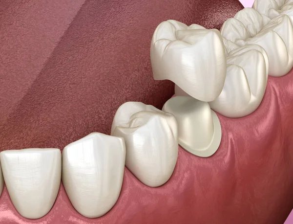 Stock image Preparated premolar tooth and dental metal-ceramic crown. Medically accurate 3D illustration