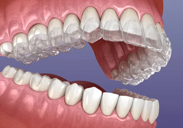 Invisalign Aparat Ortodontyczny Lub Niewidzialny Aparat Zęby Medycznie Dokładna Ilustracja — Zdjęcie stockowe