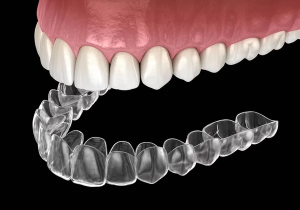 Invisalign Aparat Ortodontyczny Lub Niewidzialny Aparat Zęby Medycznie Dokładna Ilustracja — Zdjęcie stockowe