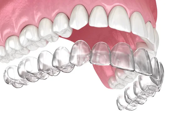 Bretelle Invisalign Fermo Invisibile Illustrazione Dentale Clinicamente Accurata — Foto Stock