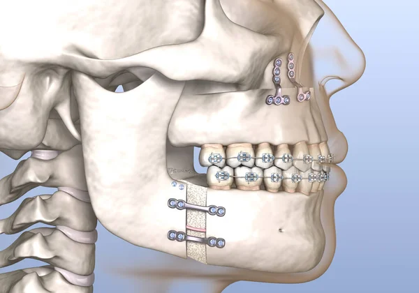 Maxillomandibular Ilerlemiş Ameliyat Tıbbi Olarak Doğru Olan Boyutlu Diş Illüstrasyonu — Stok fotoğraf