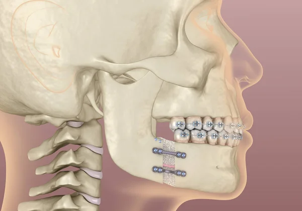 Maxillomandibular Advancement Χειρουργική Επέμβαση Ιατρικά Ακριβής Οδοντιατρική Τρισδιάστατη Απεικόνιση — Φωτογραφία Αρχείου