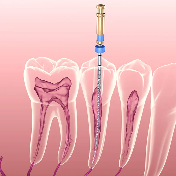 Processo Tratamento Canal Radicular Endodôntico Ilustração Dente Medicamente Precisa — Fotografia de Stock