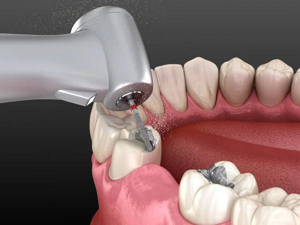 Amalgam Çıkarılıyor Seramik Taç Yerleştirme Için Hazırlanıyor Diş Konseptinin Illüstrasyonu — Stok fotoğraf