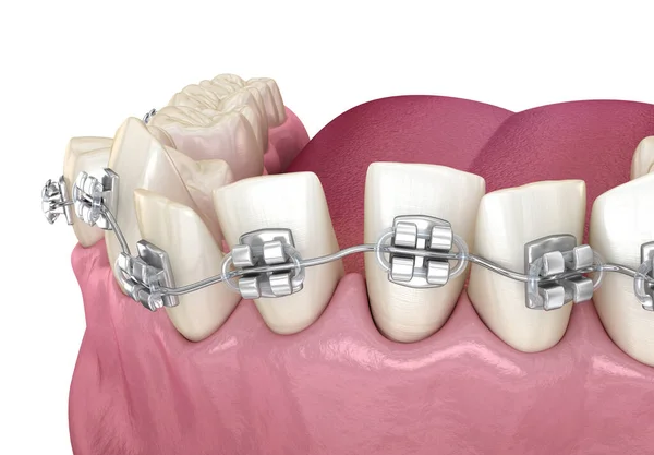 Posição Anormal Dos Dentes Tretamento Aparelho Claro Ilustração Odontológica Medicamente — Fotografia de Stock