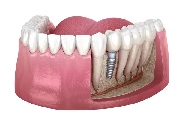 Installazione Corona Dente Premolare Sopra Impianto Abutment Illustrazione Clinicamente Accurata — Foto Stock