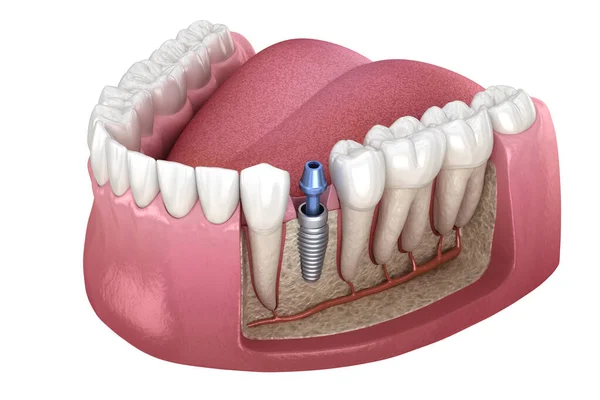 Διαδικασία Προσκόλλησης Εμφυτεύματος Ιατρικά Ακριβής Τρισδιάστατη Απεικόνιση Των Ανθρώπινων Δοντιών — Φωτογραφία Αρχείου