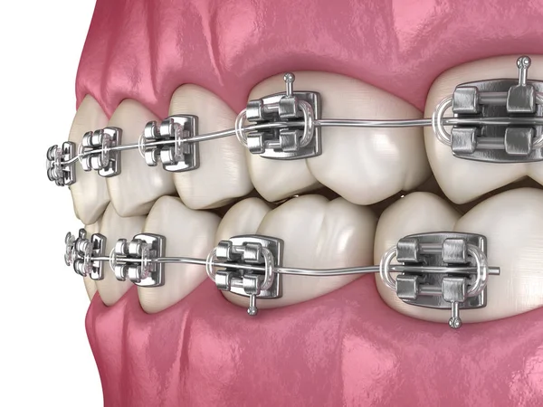 Braces Métalliques Tretament Vue Macro Illustration Dentaire Médicalement Précise — Photo
