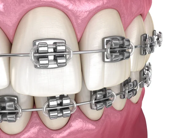 Braces Métalliques Tretament Vue Macro Illustration Dentaire Médicalement Précise — Photo
