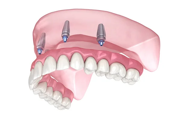 上颌骨假体 牙龈全长在4个系统上 植入物支持 医学上准确的人类牙齿和假牙3D图像 — 图库照片