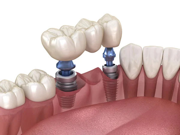 Zahnbrücke Durch Implantate Gestützt Medizinisch Genaue Abbildung Des Konzepts Menschlicher — Stockfoto