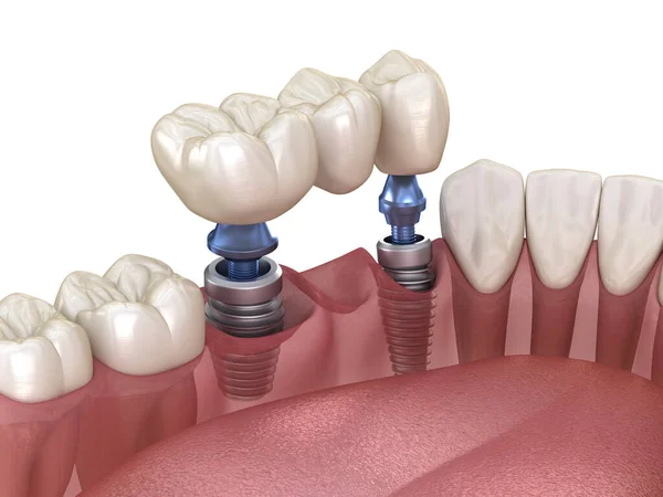 Fogászati Híd Implantátumokkal Alátámasztva Orvosilag Pontos Illusztráció Emberi Fogak Műfogsor — Stock Fotó